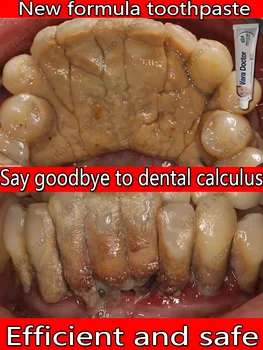 hambaravi hambakivi eemaldaja valgendamine hammaste suhu lõhna eemaldamise halb hingeõhk Vältida Parodontiit hambapasta fluoriid